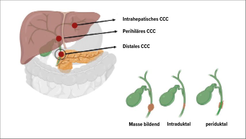 Einteilung des cholangiozellulären Karzinoms