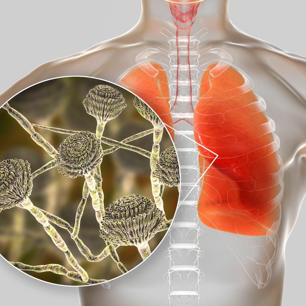 Diagnostik invasiver Mykosen Infektiologie Universimed Medizin im