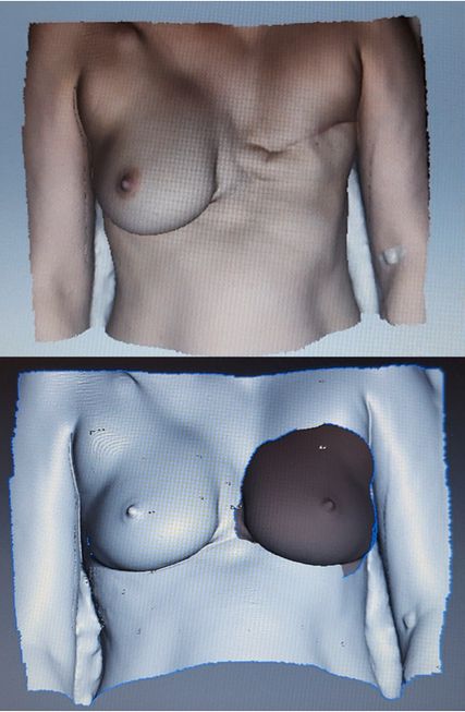 3D-Scan für eine unilaterale Brustrekonstruktion