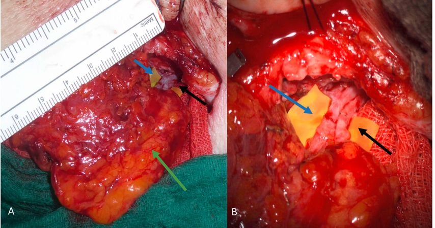 Vaskularisierter Lymphknotenlappen