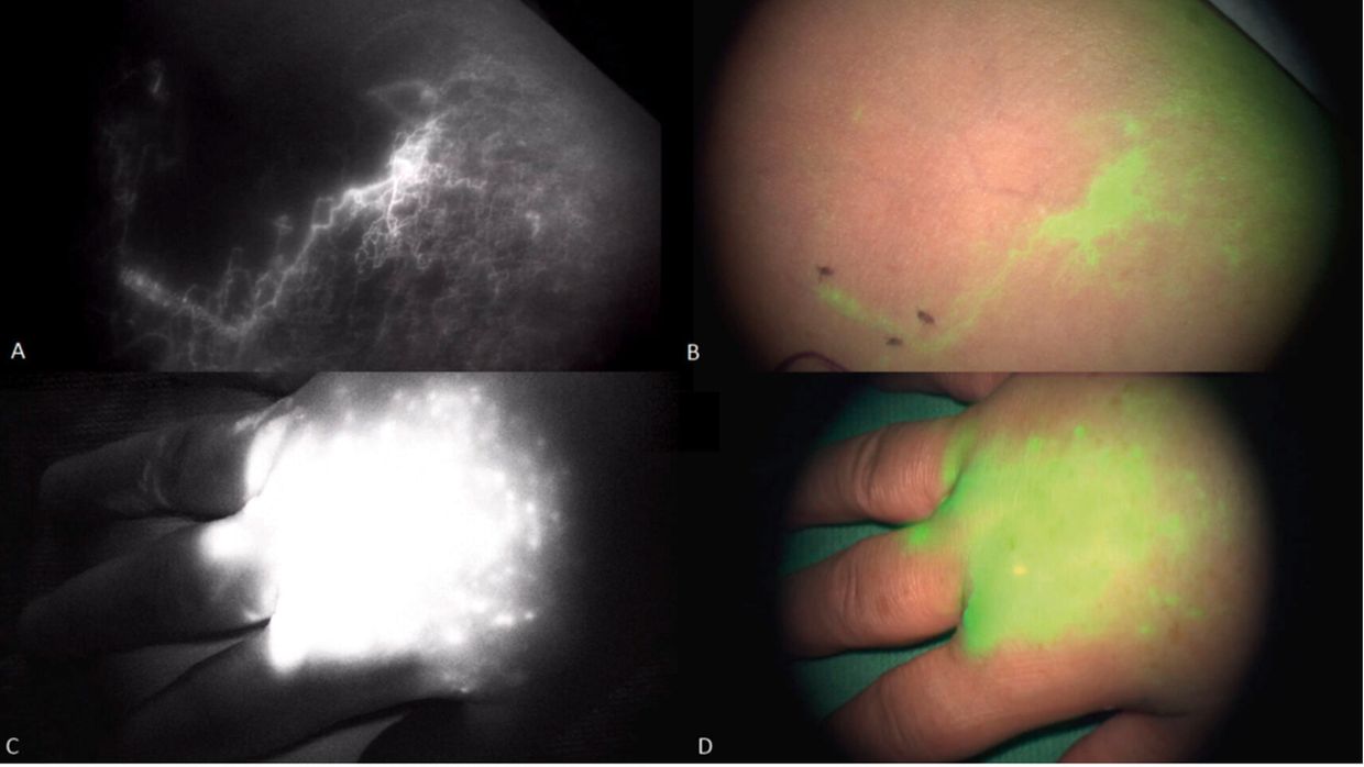 Chirurgische Therapie des Lymphödems