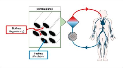 Schematische Darstellung von Aufbau und Komponenten der venovenösen extrakorporalen Membranoxygenierung