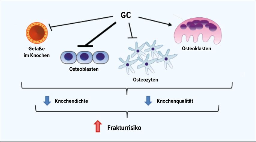 Auswirkungen von Glukokortikoiden (GC) auf den Knochen