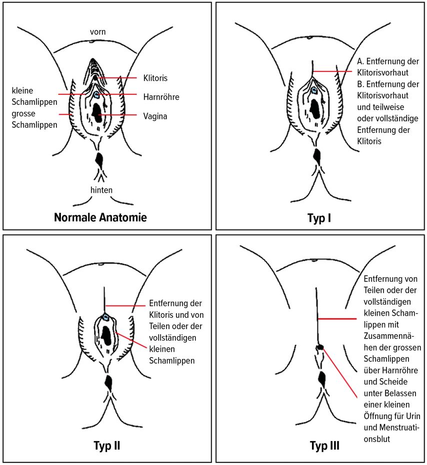 Typen I–III der FGM