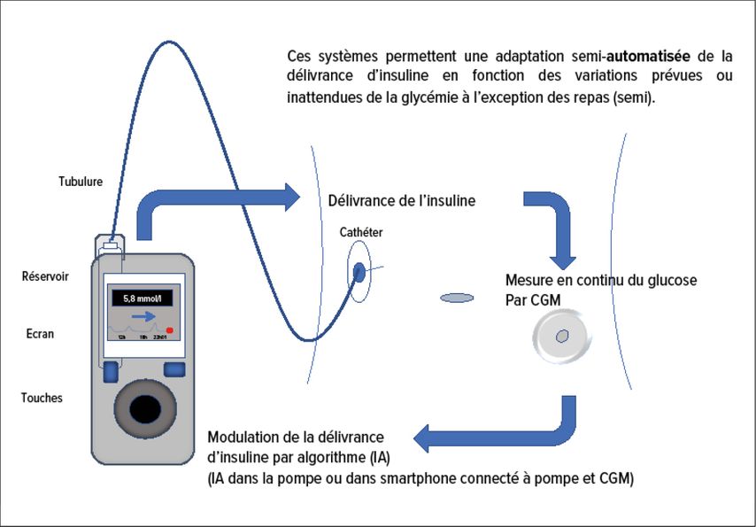 Fonctionnement des système de délivrance d’insuline en boucle semi-fermée