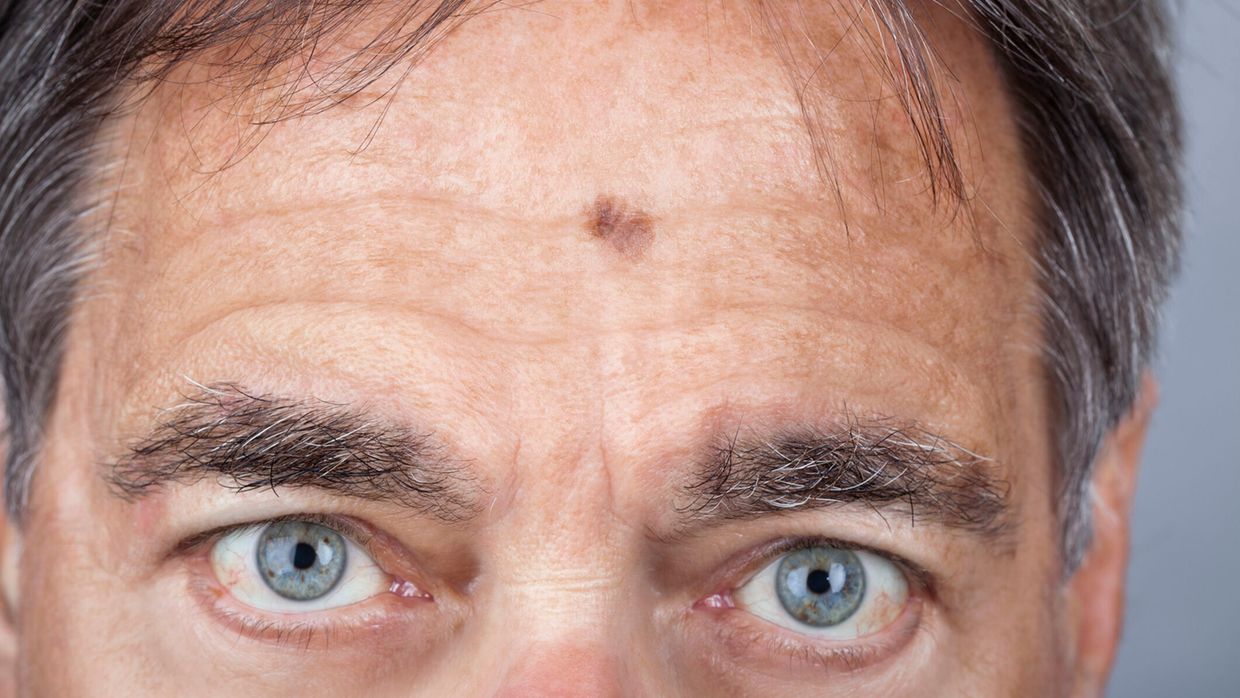 Lentigo maligna ist die Exzision immer die beste Wahl für die Patien