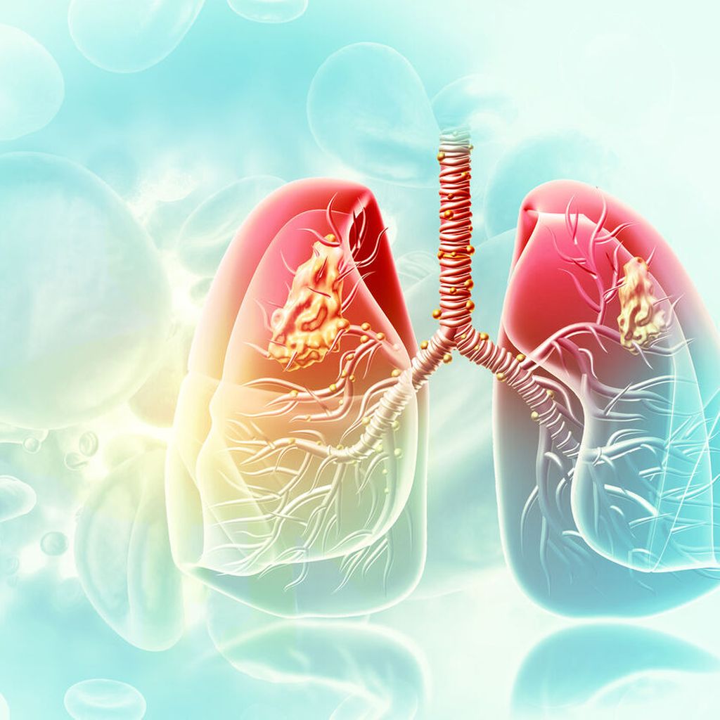 Zielgerichtete Therapie mit Amivantamab bei METExon14Mutation