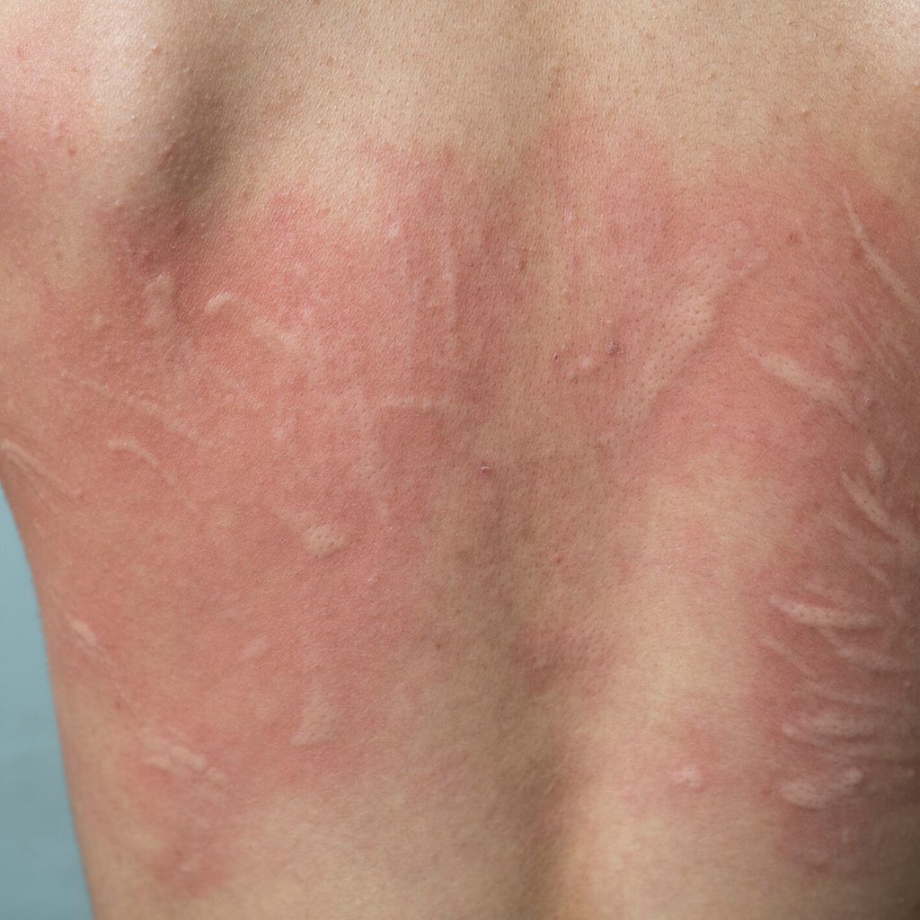 Update zu Urtikaria und Angioödem - Dermatologie - Universimed - Medizin im Fokus