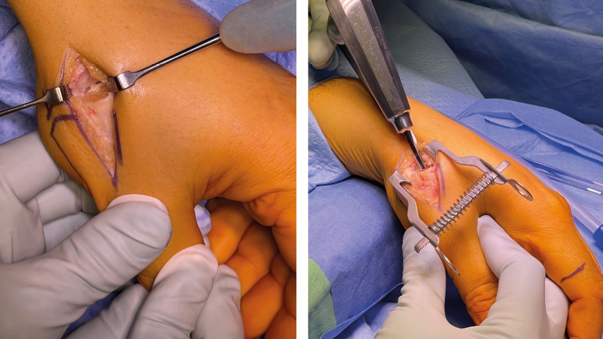 Wie aus einem Sattelgelenk ein Kugelgelenk wird - Orthopdie &  Traumatologie - Universimed - Knowledge that matters