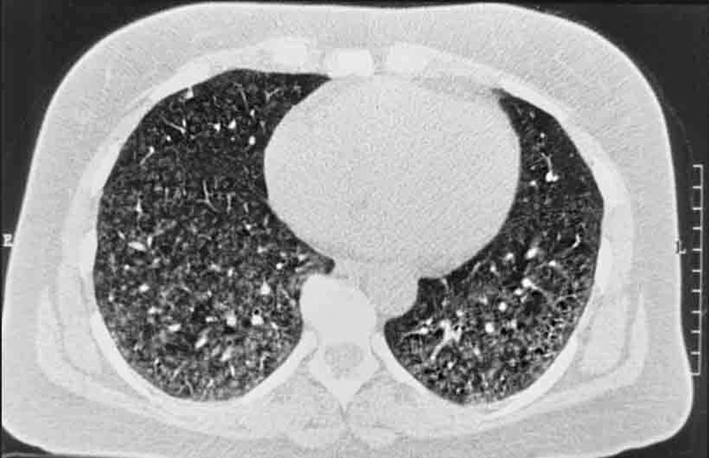 Exogen allergische Alveolitis unter besonderer Berücksichtigung der „F Pneumologie