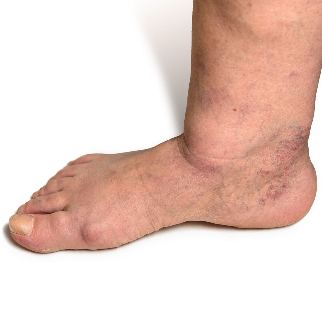 Diabetisches Fußsyndrom: Was gehört in die Ordination, was in die Fach ...