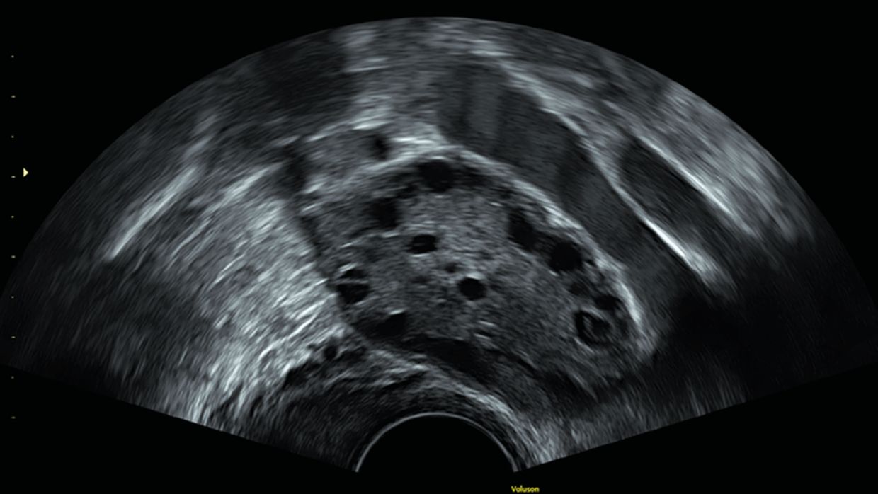 sonografische-beurteilung-der-fertilit-t-gyn-kologie-geburtshilfe