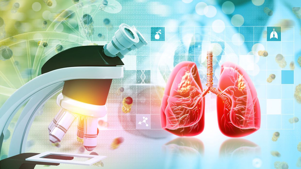 Which is the best frontline ALK inhibitor today for ALK+ lung cancer