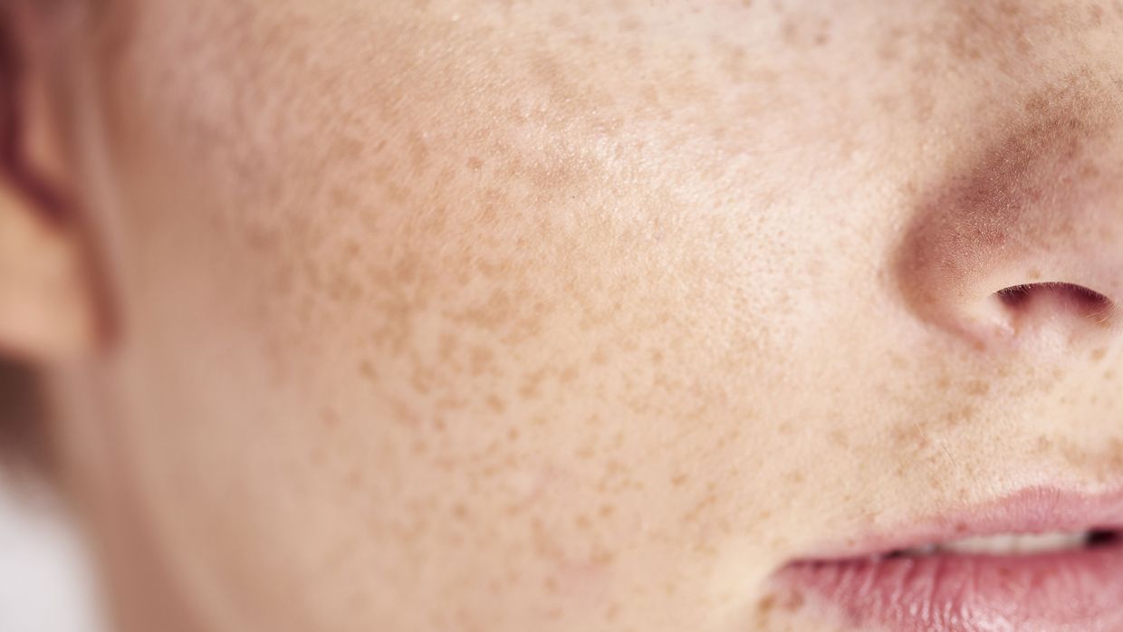 Billiges isotretinoin