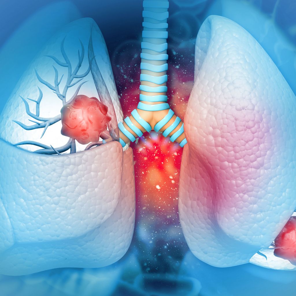 4JahresDaten bestätigen Effektivität der DurvalumabErhaltungstherap