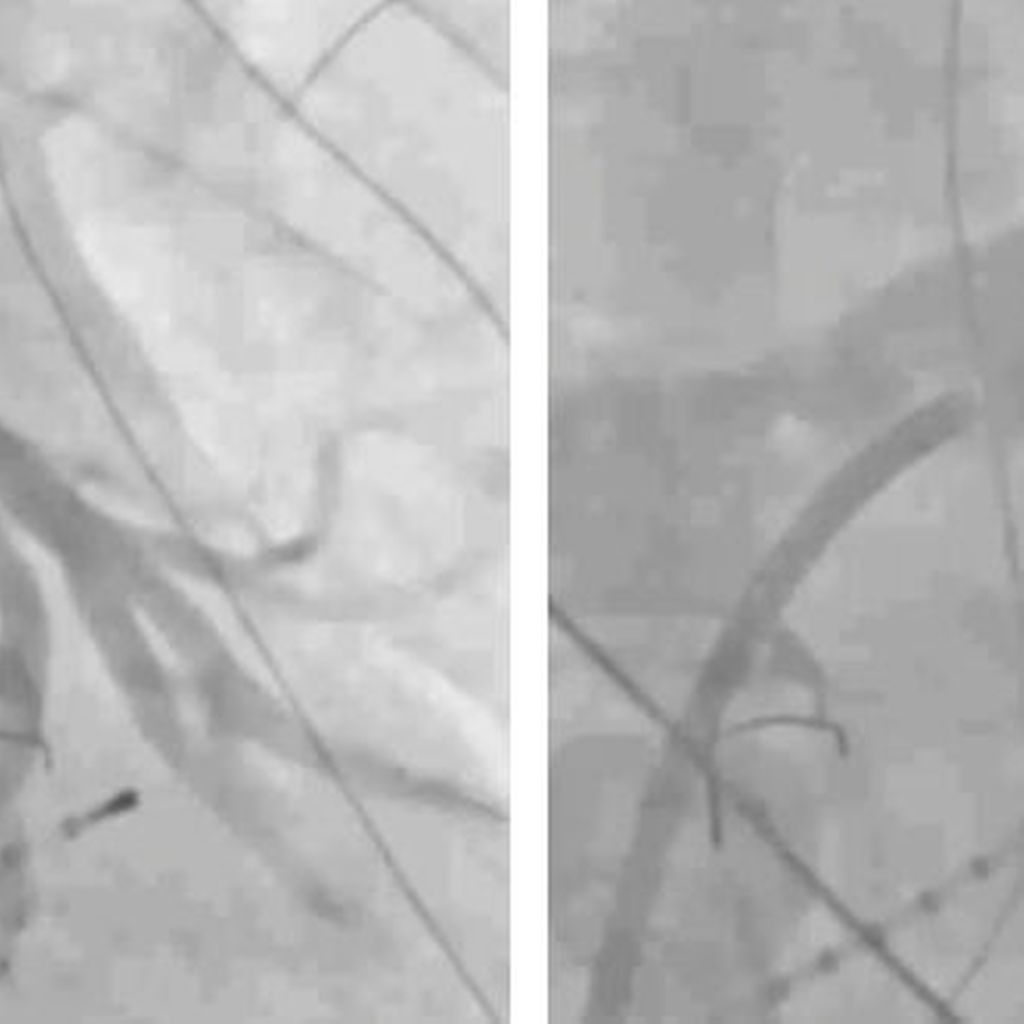 pulmonalvenenstenosen-nach-ablationsbehandlung-von-vorhofflimmern