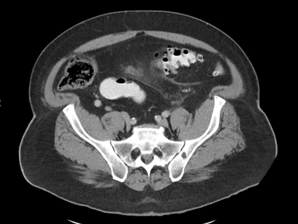 Traitement de la diverticulite sigmoïdienne – directives actualisées ...