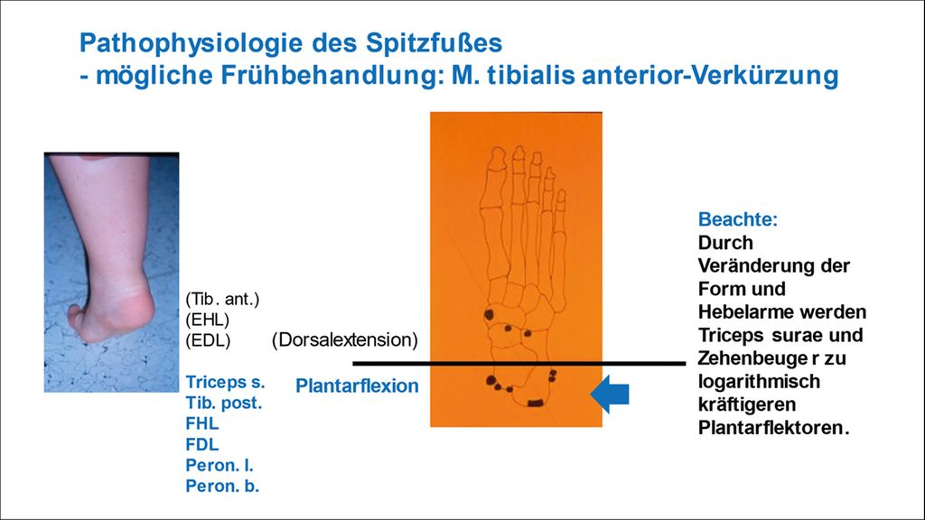 Funktionsverbessernde Sehnentransfers am Fuß - Orthopädie ...