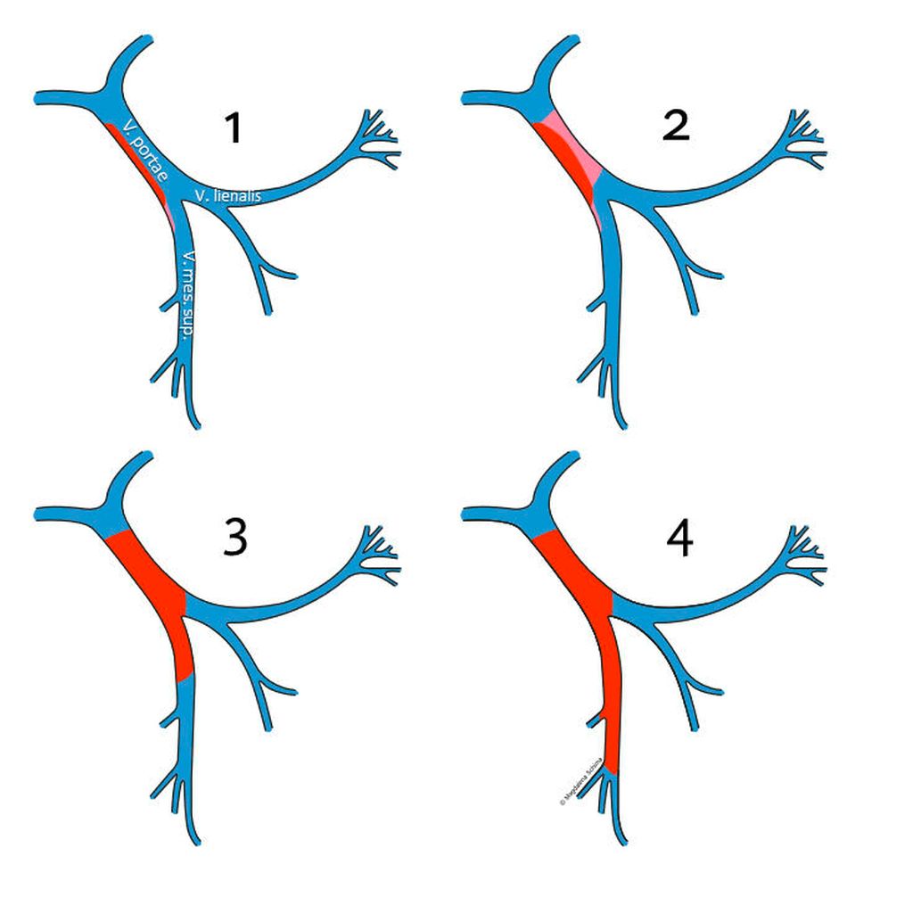 Pfortaderthrombose: Risikofaktoren, bildgebende Diagnostik, Komplikati ...