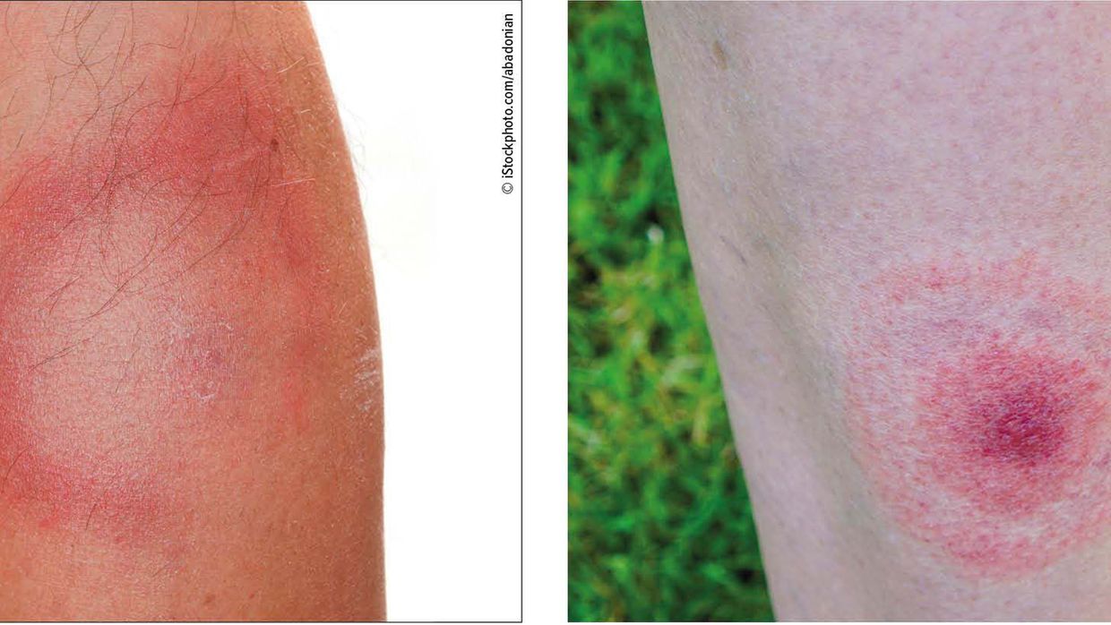 Wann ist borreliose im blut nachweisbar ? - BildFragen.de