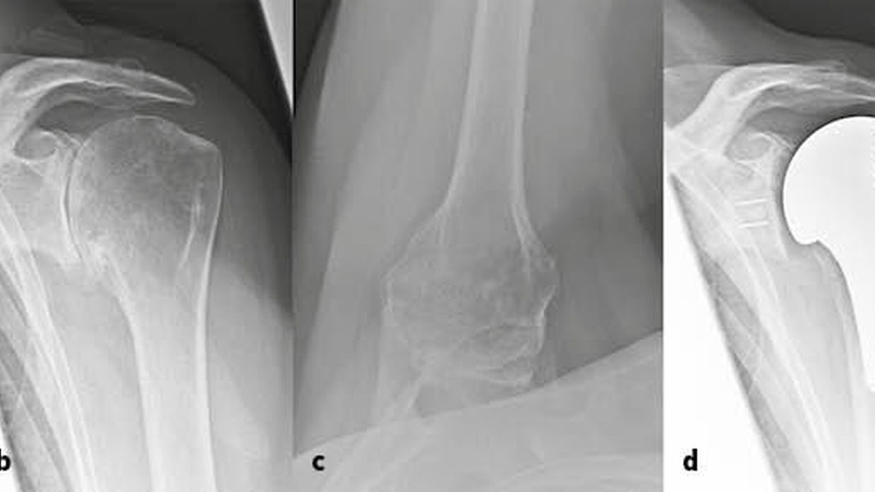 When is anatomic shoulder arthroplasty the best solution for patients