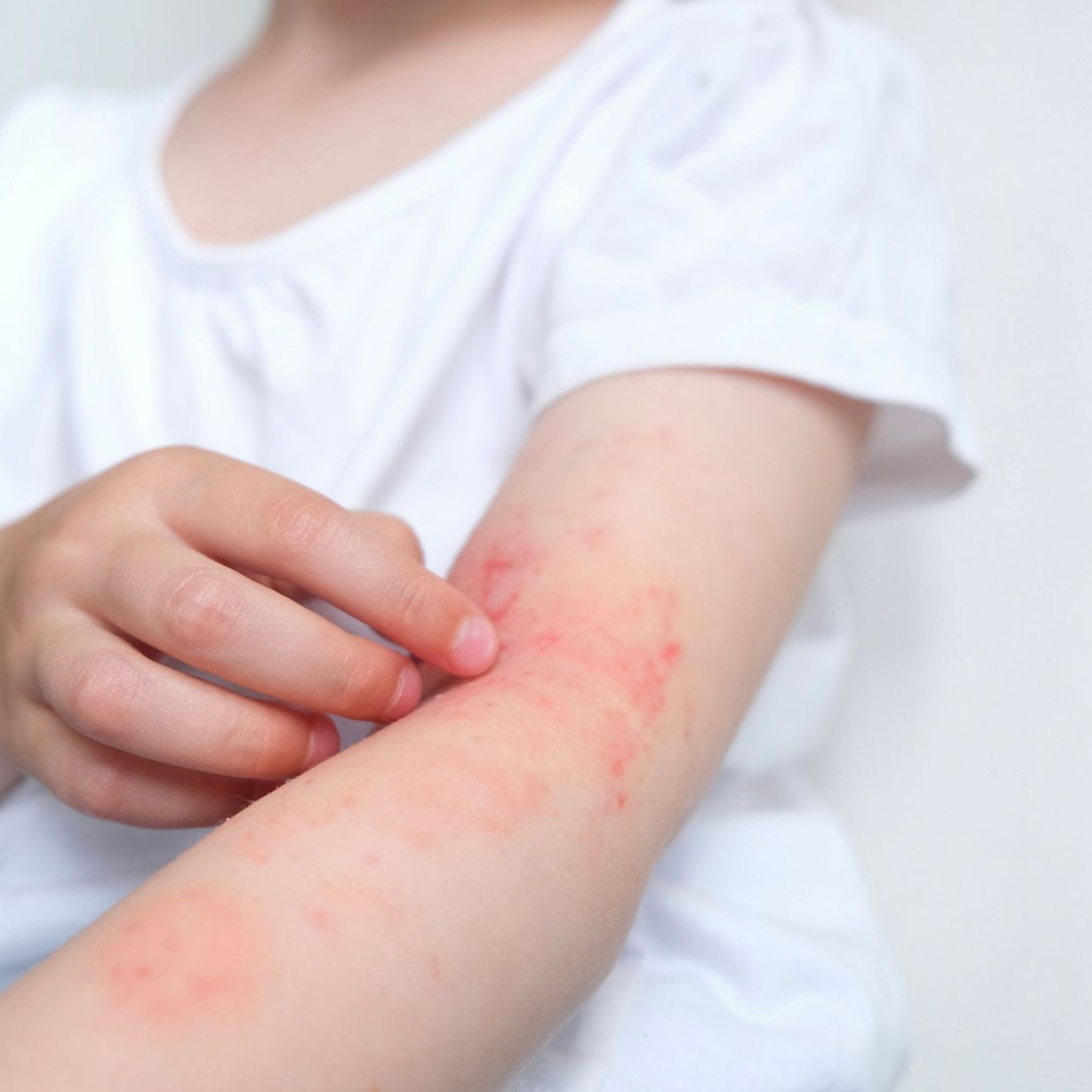 Mit frher Intervention den atopischen Marsch aufhalten? - Dermatologie -  Universimed - Medizin im Fokus
