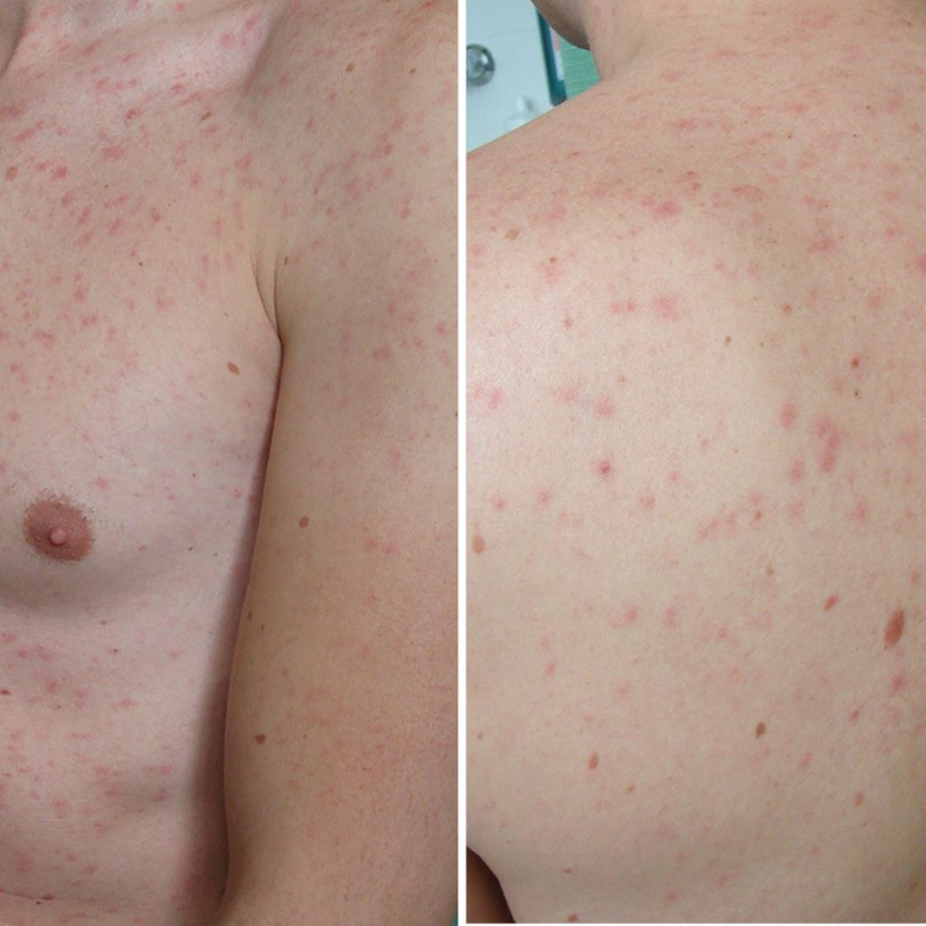 Erstlingsexanthem als essenzieller Hinweis auf Primoinfektion -  Dermatologie - Universimed - Medizin im Fokus