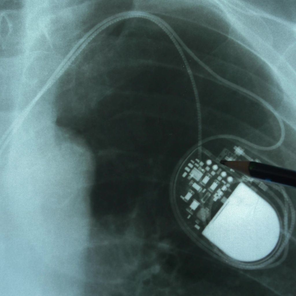 ICD Neue Indikationen Und Neue Technologien Kardiologie 