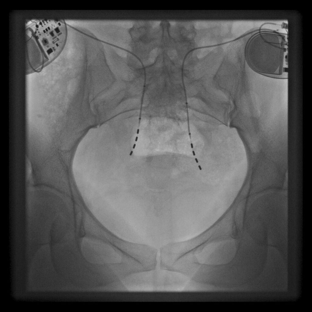 Sakrale Neuromodulation bei Harninkontinenz - Gynäkologie ...