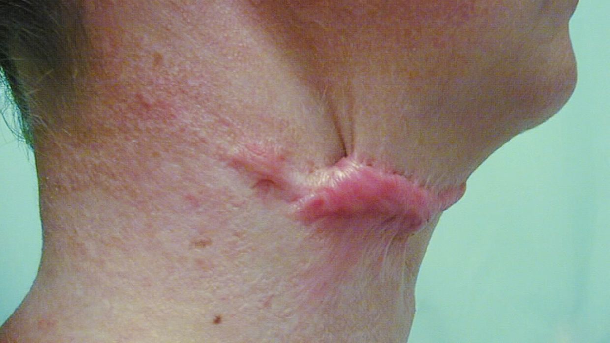 Narbenbehandlungen und Korrektureingriffe in der Praxis - Plastische  Chirurgie - Universimed - Knowledge that matters