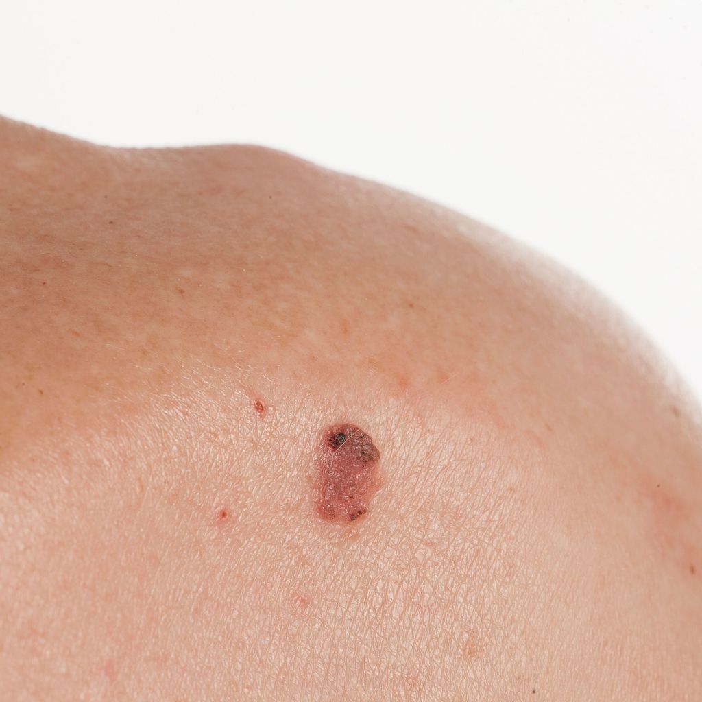 Aktuelle Empfehlungen Zur Systemtherapie Des Melanoms Onkologie gastroenterologie-trifft-dermatologie-seltene-erkrankungen-des-sopha