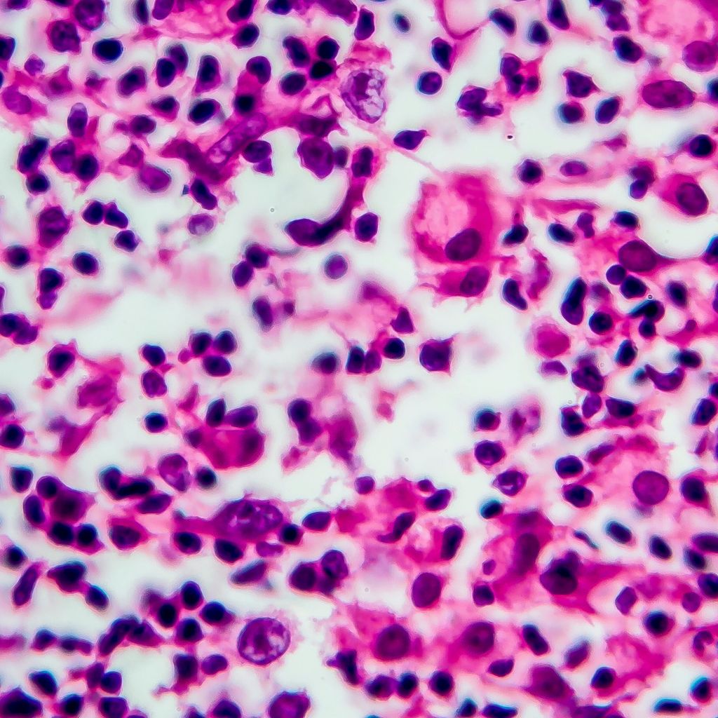 Neue Standards Bei Lymphomtherapie Onkologie Universimed Medizin 