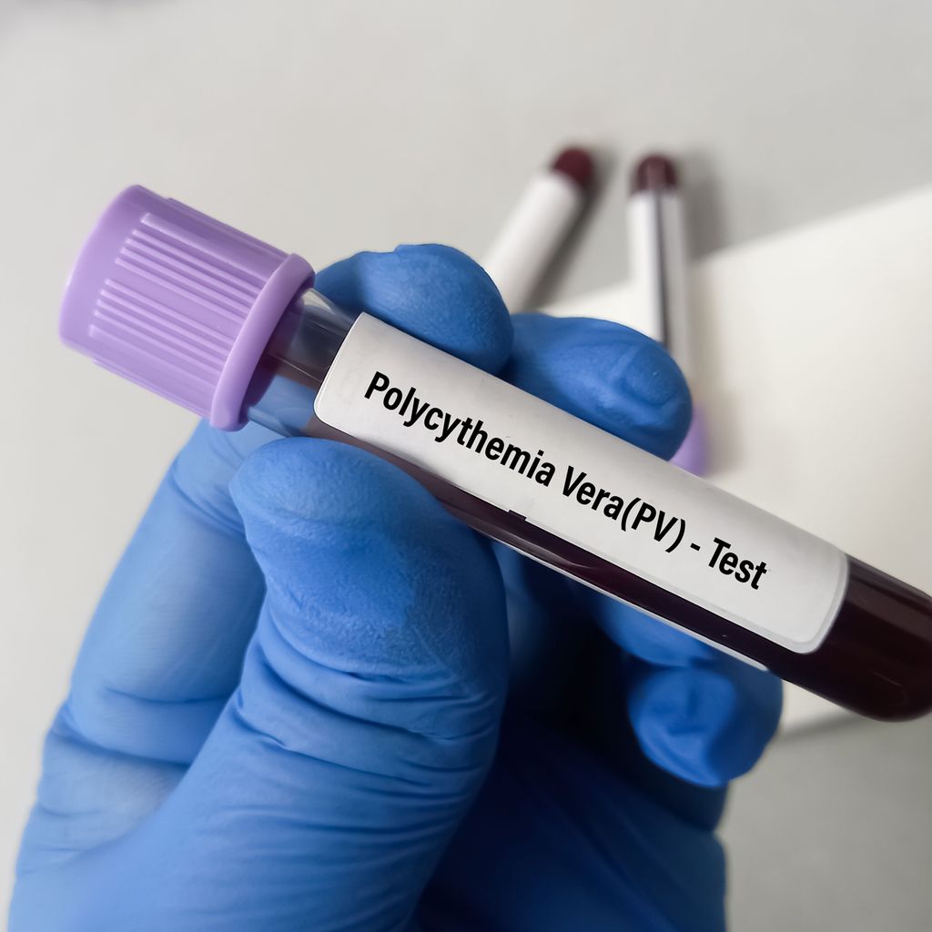 polycythaemia-vera-aderlass-ist-out-h-matologie-universimed