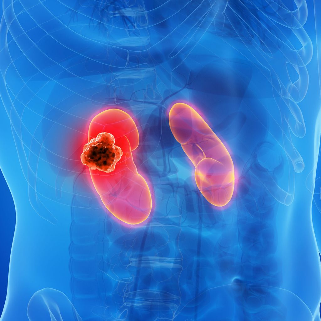 Nierenzellkarzinom: Update zu Diagnostik, Therapie und translationaler -  Urologie & Andrologie - Universimed - Knowledge that matters