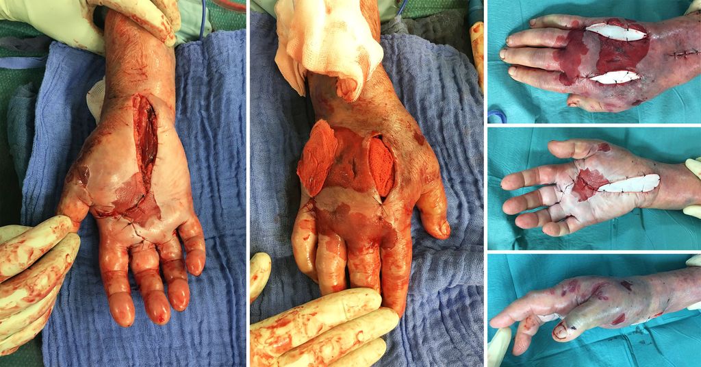 Das akute Kompartmentsyndrom der Extremitäten Orthopädie