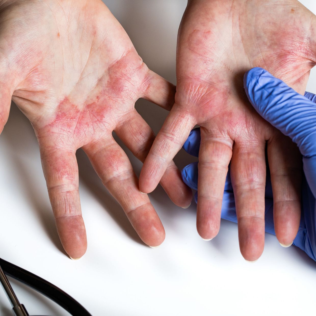 Kontaktdermatitis im Fokus - Dermatologie - Universimed - Knowledge that  matters