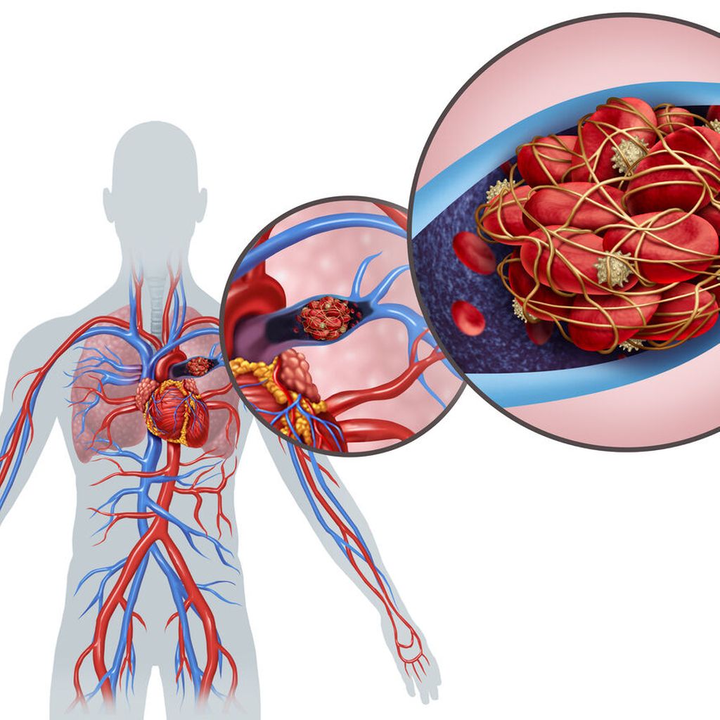 Diagnostic et traitement de l'embolie pulmonaire aigu - Mdecine interne -  Universimed - Knowledge that matters