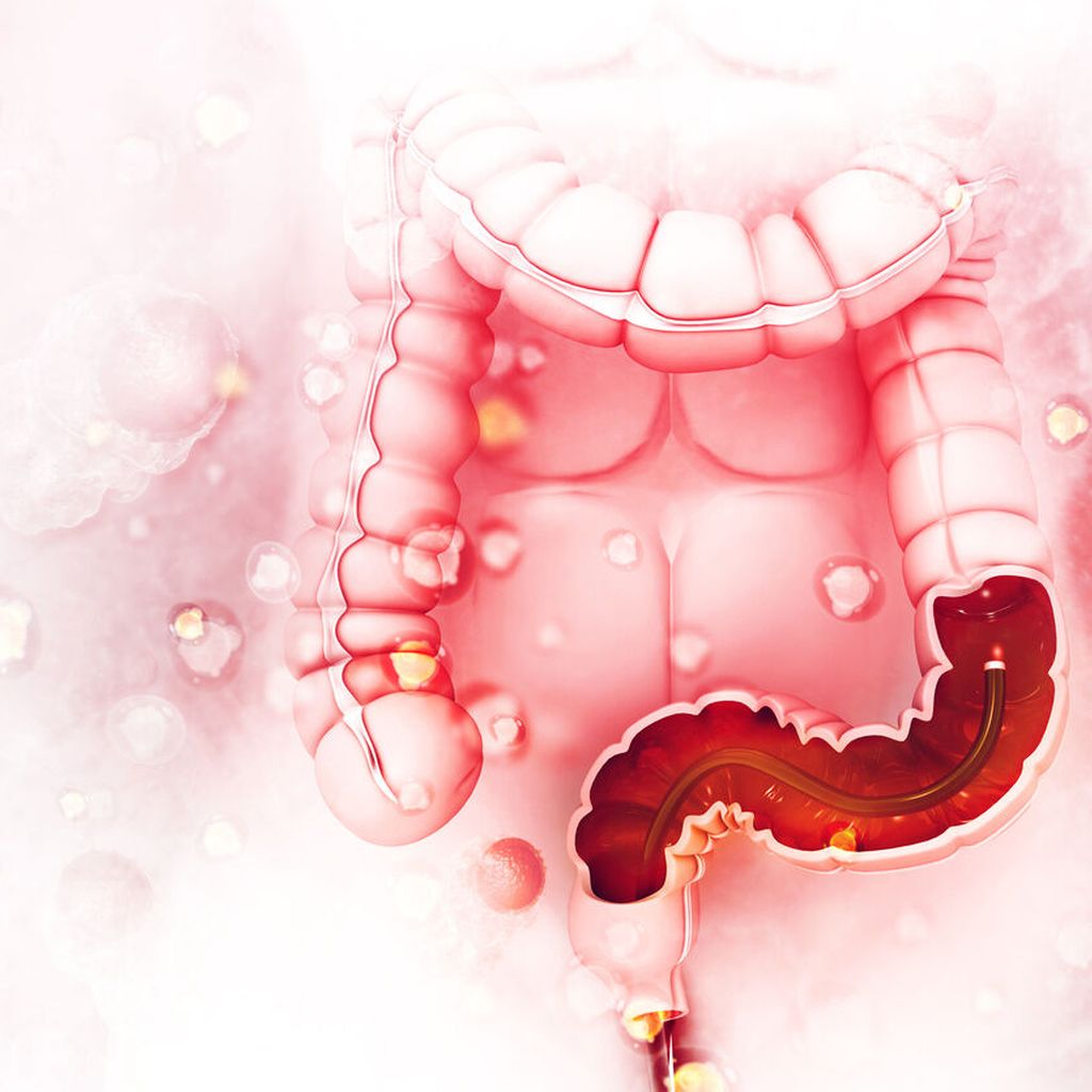 HeadtoheadVergleich von Cetuximab und Bevacizumab kombiniert mit FO