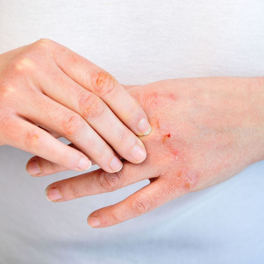Das A und O sind Schutzhandschuhe - Dermatologie - Universimed - Knowledge  that matters