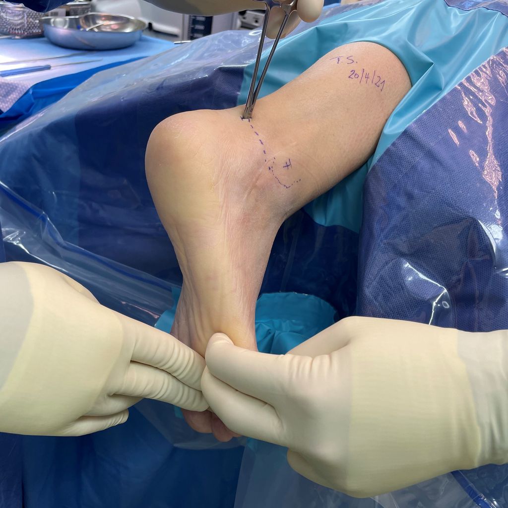 Die arthroskopische Versteifung des unteren Sprunggelenks - Orthopädie & Traumatologie ...