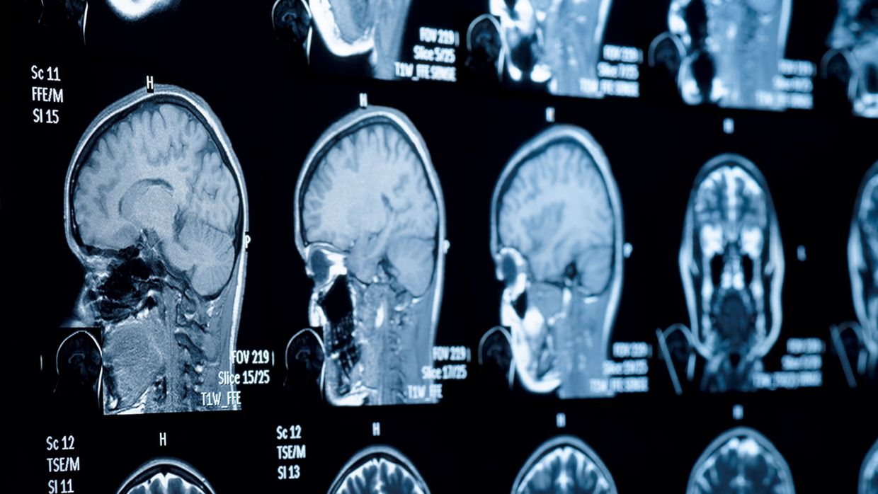 Neue Therapieoptionen bei seltenen Kopf-Hals-Tumoren - Onkologie - Universimed - Medizin im Fokus