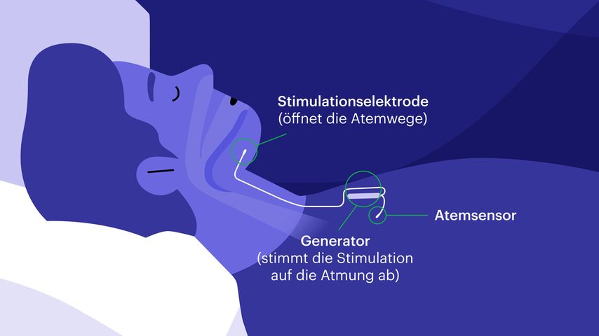 Wirkweise des Hypoglossus-Schrittmachers