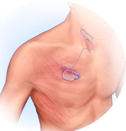 Darstellung des Hypoglossus-Schrittmachers