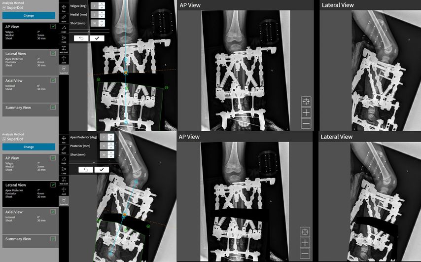 Bei der „SuperDot“-Planung kann das Moving-Fragment, in diesem Fall das distale Segment, einfach in die gewünschte Position gezogen und rotiert werden.