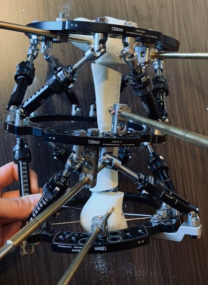 Für die neueste Generation des TSF stehen vier Strut-Familien zur Verfügung, wobei Smart-Standard- und Smart-FX-Struts eine Distraktion mit 0,25-mm-Schritten ermöglichen. Die Struts können an unterschiedlichen Positionen fixiert werden und Step-off-Plates erlauben das Fixieren der Struts außerhalb und unterhalb des Rings, was die Montage besonders bei sehr komplexen Fehlstellungen und kleinen Knochen vereinfacht bzw. ermöglichtFür die neueste Generation des TSF stehen vier Strut-Familien zur Verfügung, wobei Smart-Standard- und Smart-FX-Struts eine Distraktion mit 0,25-mm-Schritten ermöglichen. Die Struts können an unterschiedlichen Positionen fixiert werden und Step-off-Plates erlauben das Fixieren der Struts außerhalb und unterhalb des Rings, was die Montage besonders bei sehr komplexen Fehlstellungen und kleinen Knochen vereinfacht bzw. ermöglicht