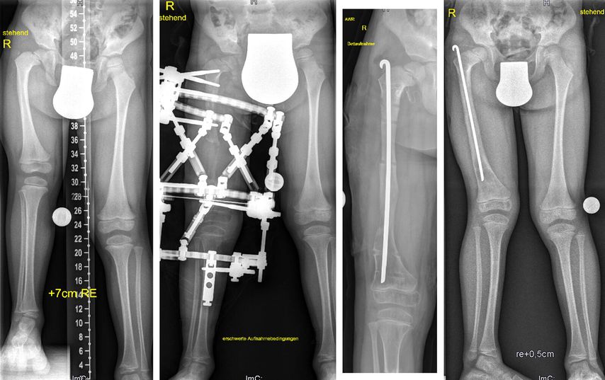 Bei diesem 4-jährigen Patienten mit kongenitalem Femurdefekt (CFD) erfolgten eine Verlängerung und Achskorrektur am distalen Femur mittels TSF.