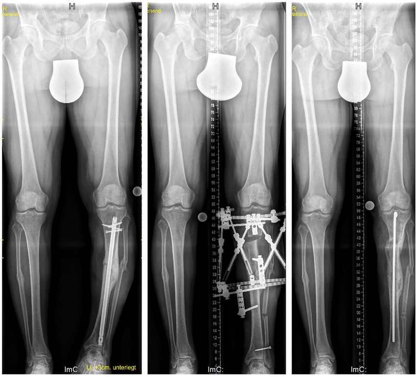 Dieser 42-jährige Patient erlitt eine offene Unterschenkelfraktur, die sich trotz initialen Fixateurs externe infizierte. Es erfolgten eine Lappenplastik und schließlich eine Osteosynthese mit Marknagelung.