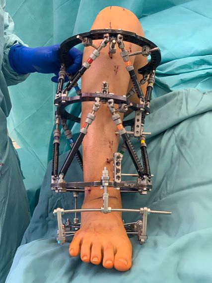 Für eine gute Stabilität der Ringmontage ist die entsprechende Verteilung der Half-Pins ausschlaggebend. Bei starken Fehlstellungen sollen die Pins bis nahe an die Fraktur/Osteotomie heranreichen.