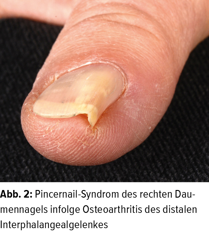 therapeutische herausforderung nagelveranderungen dermatologie universimed medizin im fokus