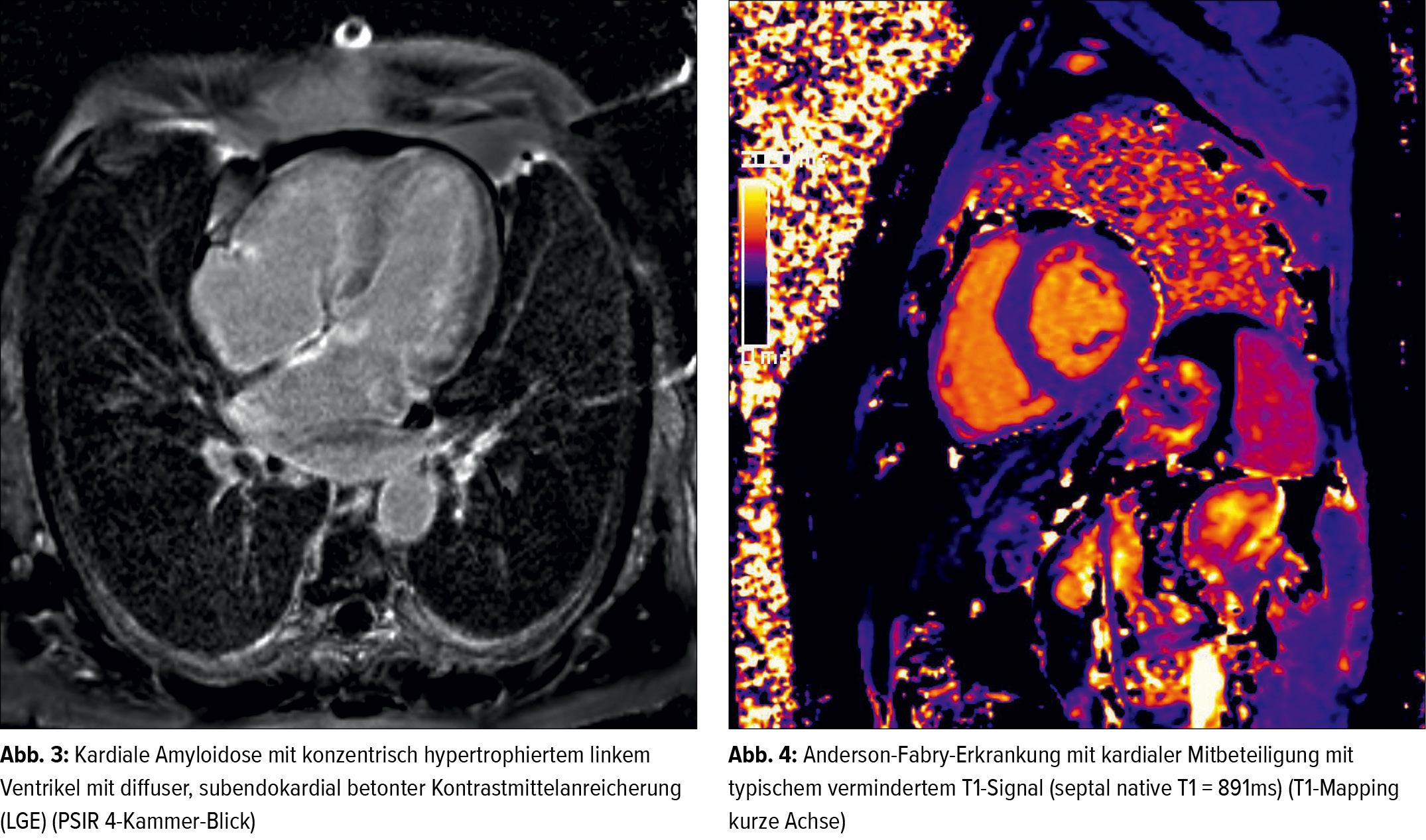 Kardiale Magnetresonanztomografie Bei Herzinsuffizienz Kardiologie Gefassmedizin Universimed Medizin Im Fokus
